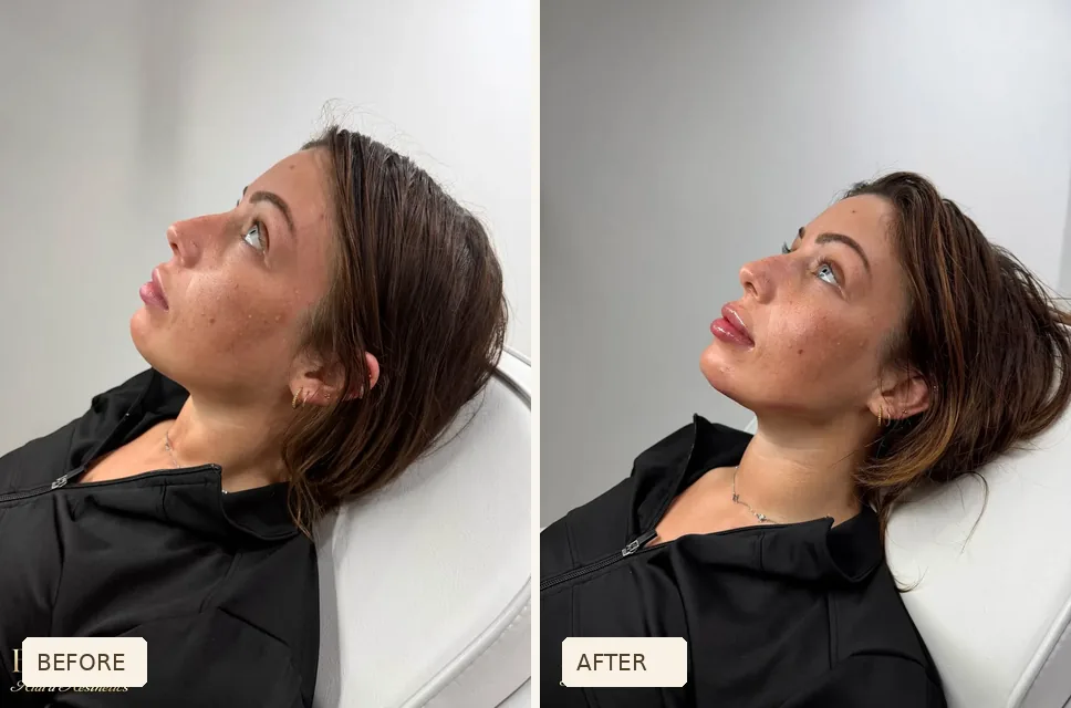 Side-profile comparison of the same consenting patient before and after treatment