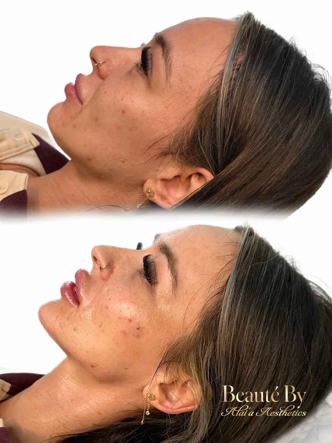 Second consenting patient before and after profile comparison