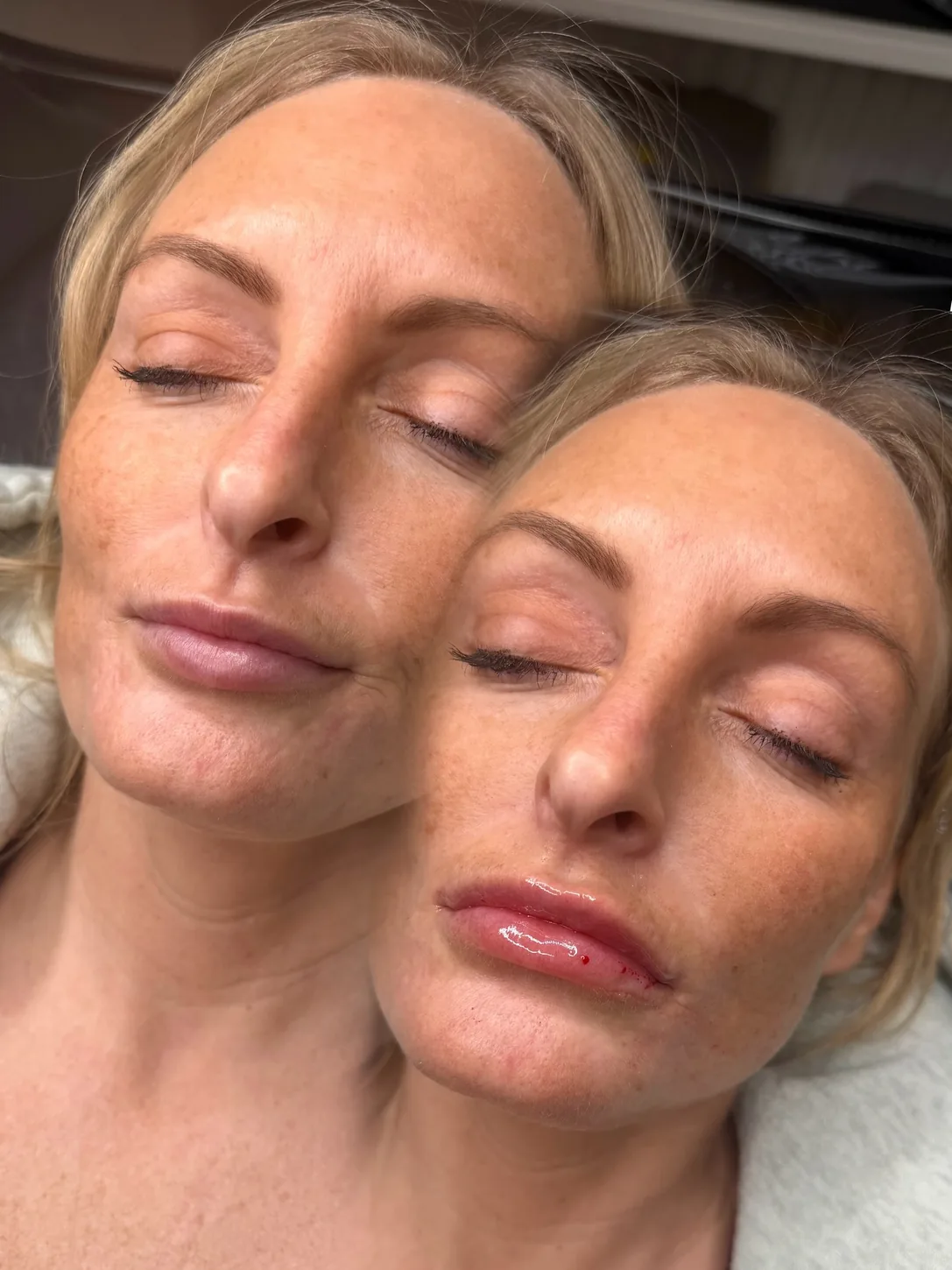 Third consenting patient lip enhancement before-and-after composite